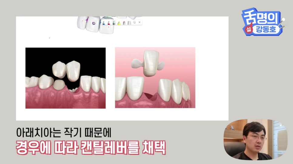 신림동치과, 브릿지치료 치아삭제 부담된다면? 관련 이미지 7