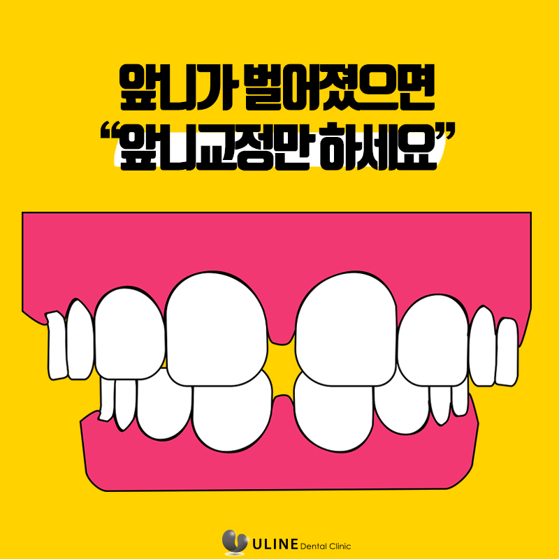 돌출앞니부분교정 탈출 후기 궁그맹! 관련 이미지 6