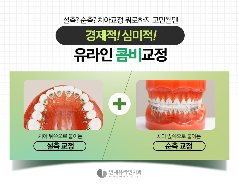 설측교정가격 하나의 우수한 심미 개선안 관련 이미지 7