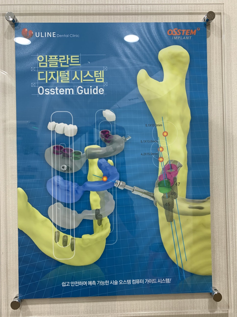 노인임플란트종류 통증과 가격을 알맞게 관련 이미지 5