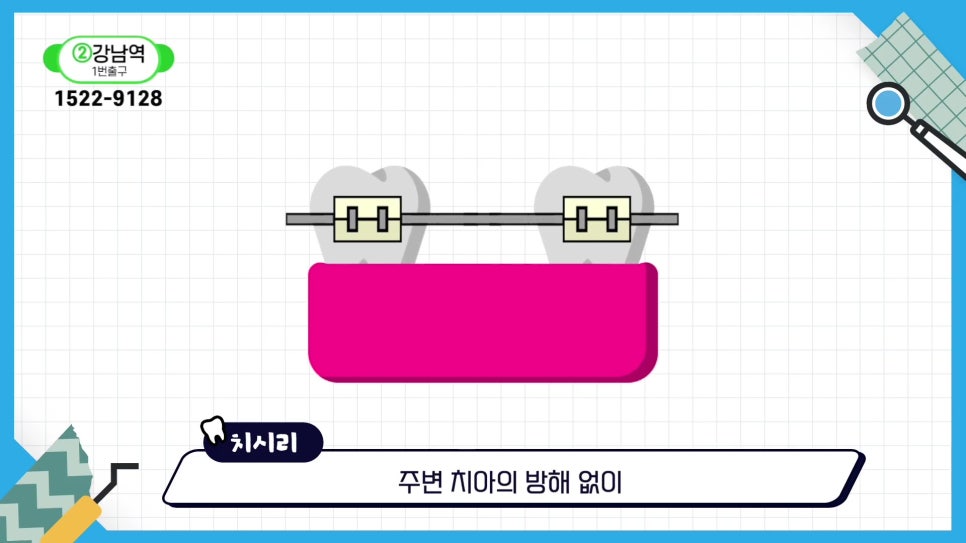 역삼동치과, 치아 빠진 뒤 빠르게 대처해야 하는 이유 관련 이미지 14