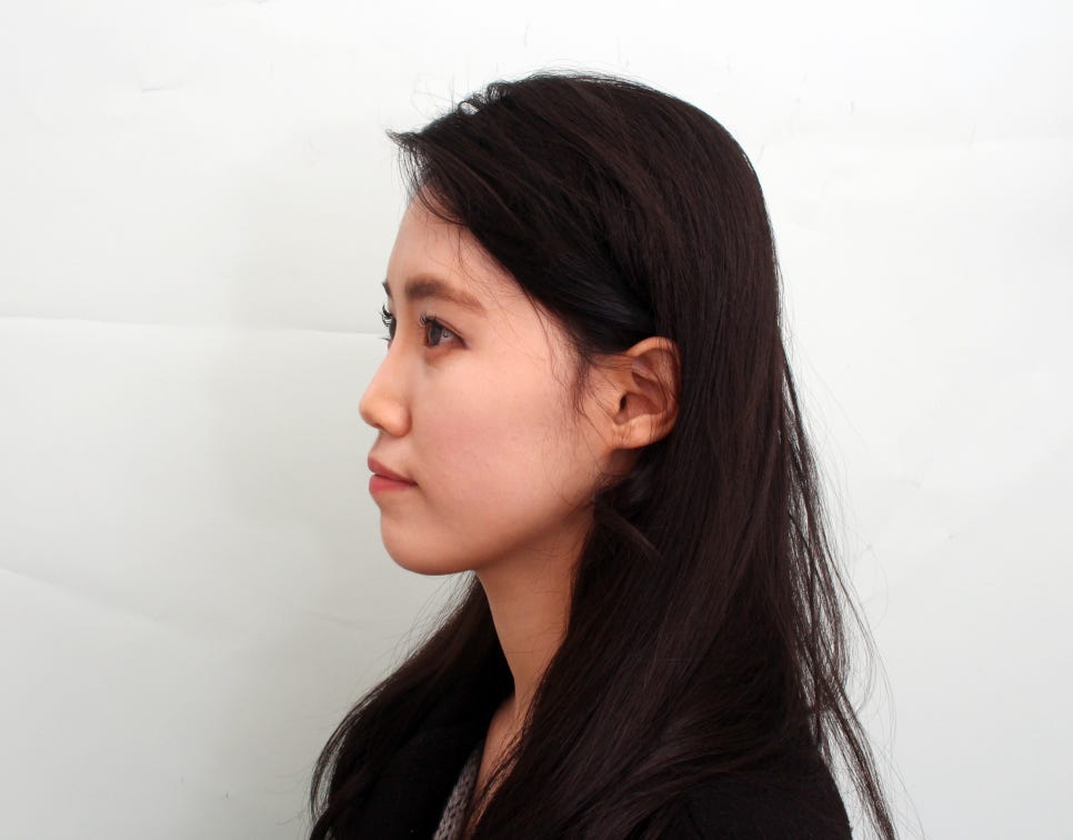 서초동치과 인상변화를 미리 알아보기 관련 이미지 3