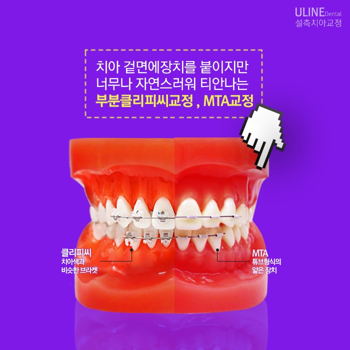 앞니부분교정후기 듣고 시작했어요! 관련 이미지 8