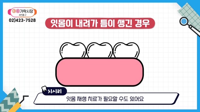 Can the Gaps Between Your Teeth That Make You Look Older Be Fixed? image 27