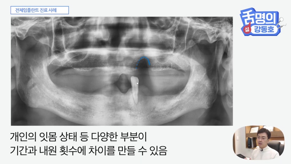 관악구치과 - 전체 임플란트, 시간&middot;횟수&middot;개수 총정리 관련 이미지 8