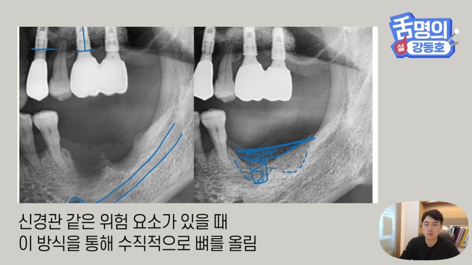 강남역임플란트, 뼈이식 왜 필요해? 관련 이미지 25