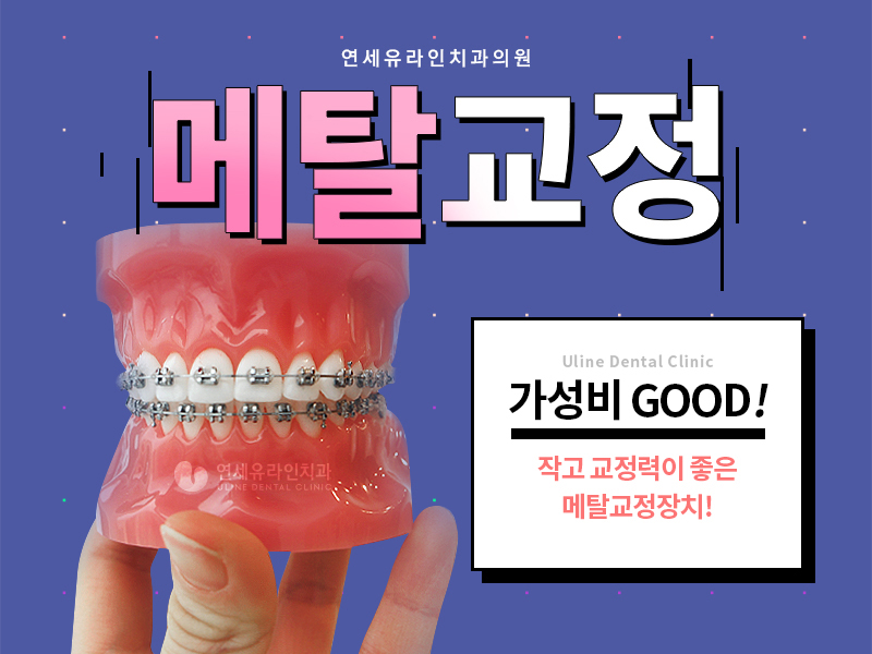 돌출입 세라믹교정 메탈교정 뭐가 좋을까! 관련 이미지 2