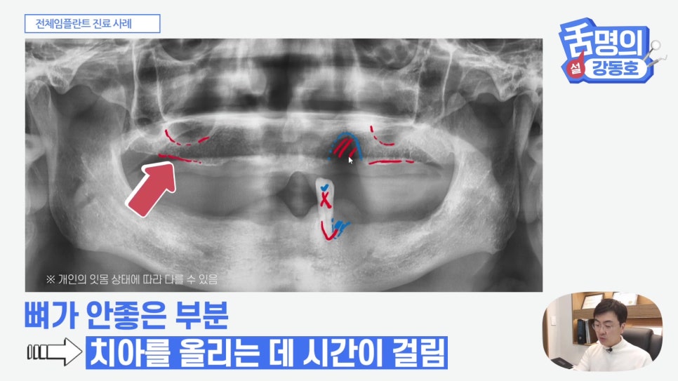 관악구치과 - 전체 임플란트, 시간&middot;횟수&middot;개수 총정리 관련 이미지 11