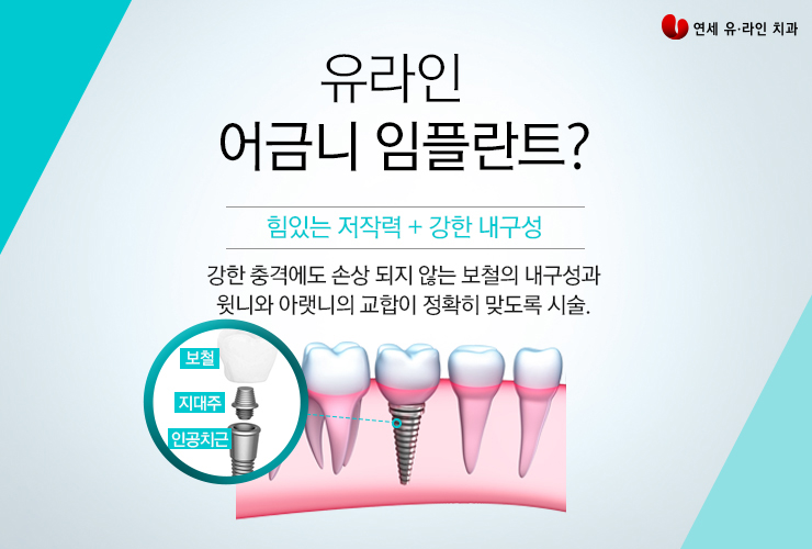 어금니임플란트잘하는곳 좋은결과 안내해줄 관련 이미지 3