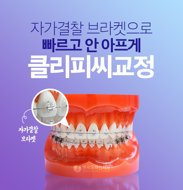 클리피씨교정기간 예상한 시간 보다 빨리! 관련 이미지 1
