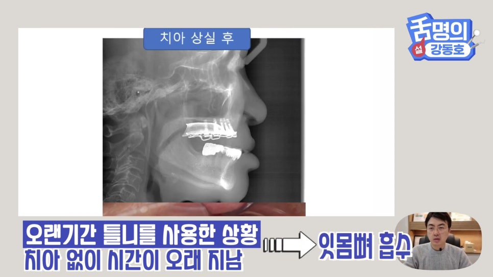 Dental Implants at Sillim Station: When There Is Not Enough Jawbone image 1