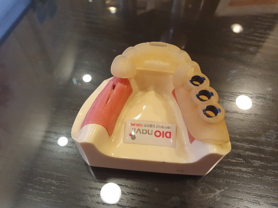 부분틀니가격으로 확실히 편해지나요? 관련 이미지 3