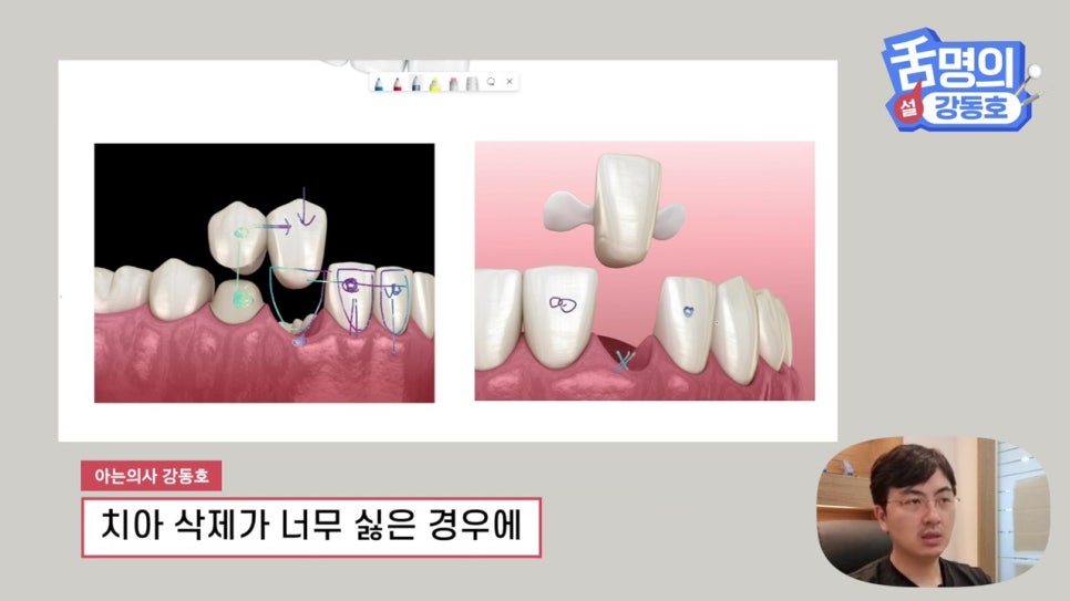 신림동치과, 브릿지치료 치아삭제 부담된다면? 관련 이미지 16