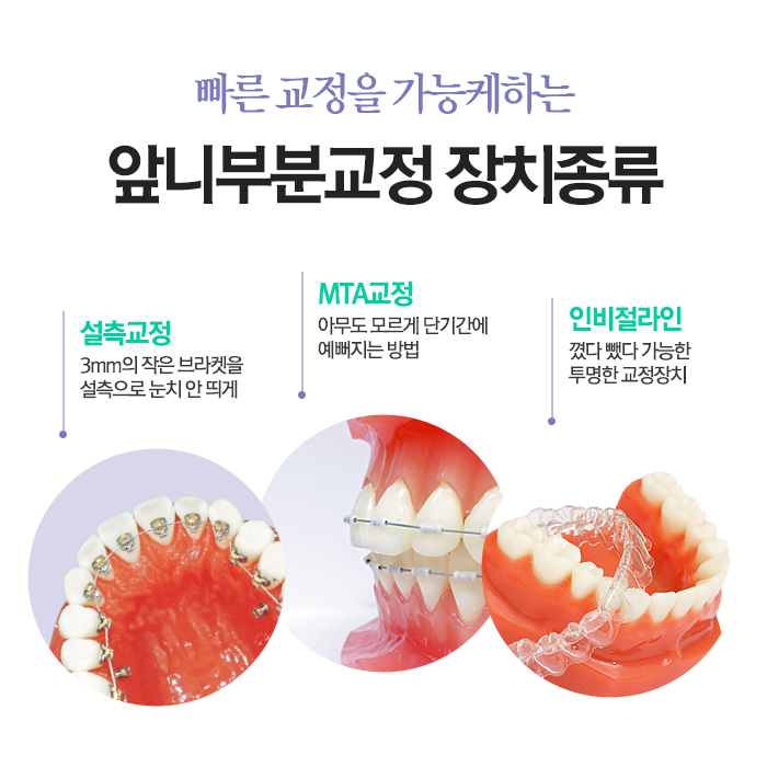 앞니부분교정비용 쉬운 과정 밟고싶다면 관련 이미지 6