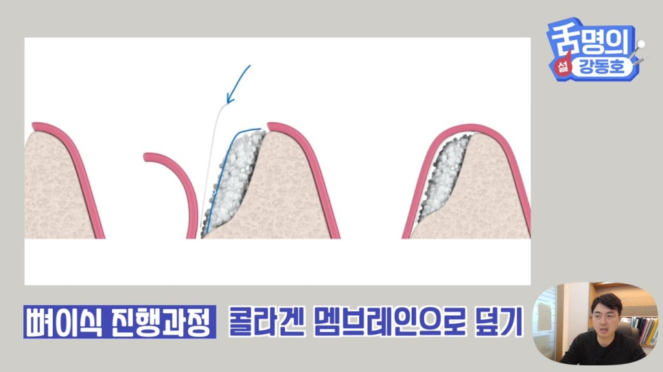 강남역임플란트, 뼈이식 왜 필요해? 관련 이미지 15