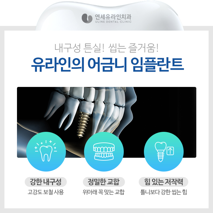 관악구치과 어금니임플란트가격대비 끝내줘 관련 이미지 3