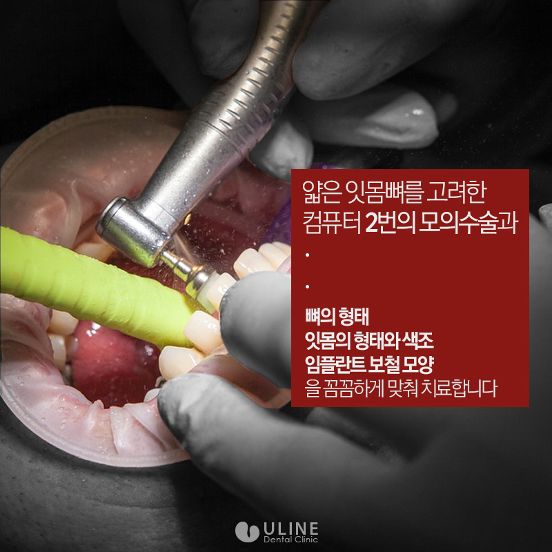 앞니임플란트가격 결과 모두 좋아 관련 이미지 4