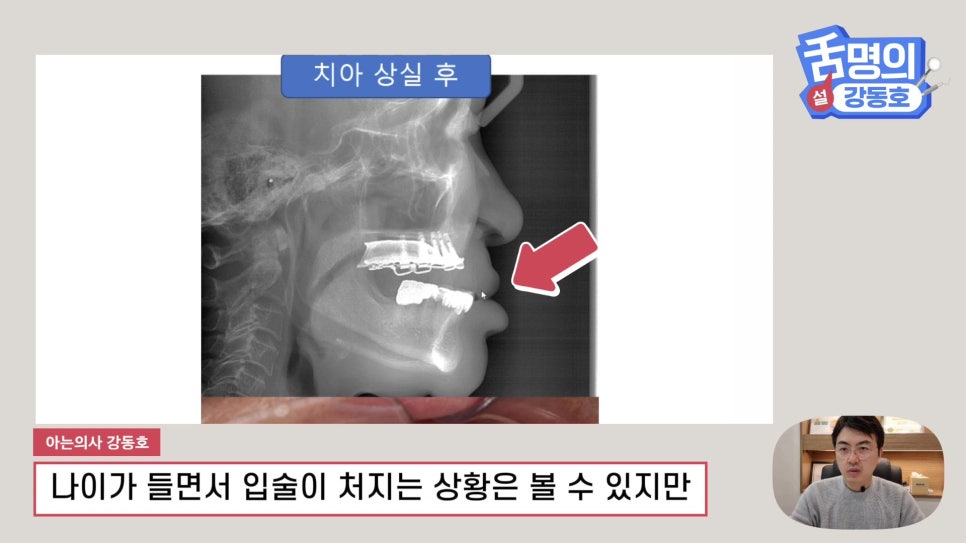 Dental Implants at Sillim Station: When There Is Not Enough Jawbone image 2