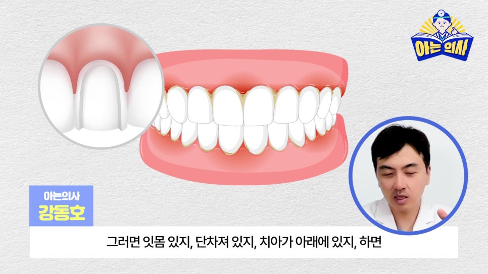 무삭제라미네이트, 단점 알고해야 관련 이미지 11
