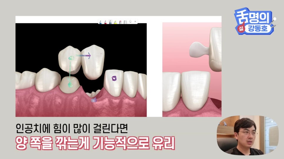신림동치과, 브릿지치료 치아삭제 부담된다면? 관련 이미지 9