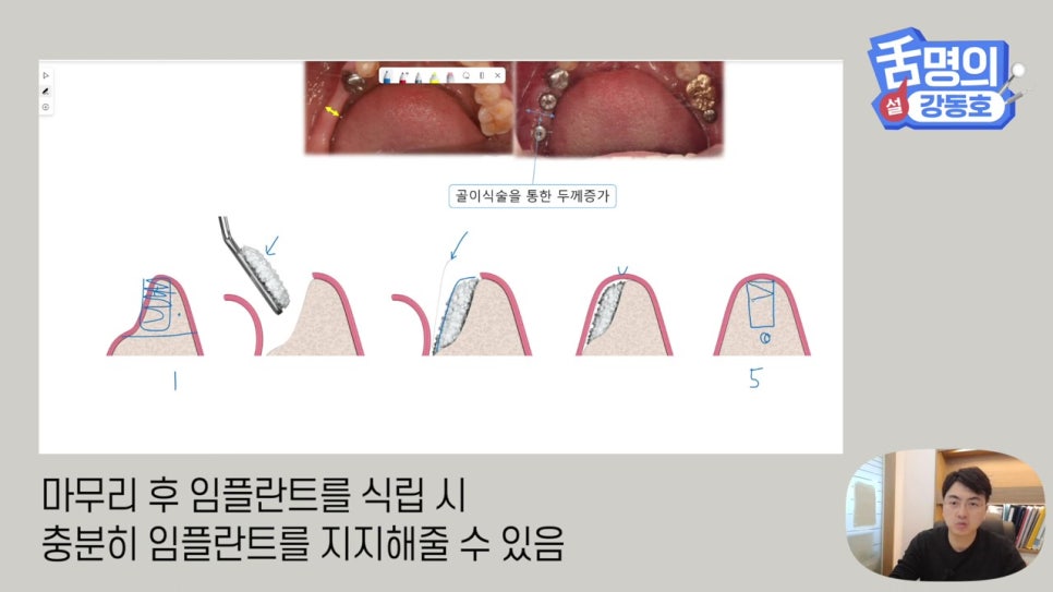강남역임플란트, 뼈이식 왜 필요해? 관련 이미지 17