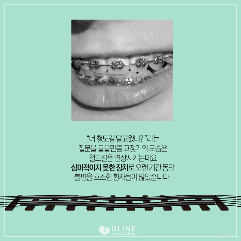 설측교정후기 제대로 알고 스타트! 관련 이미지 2