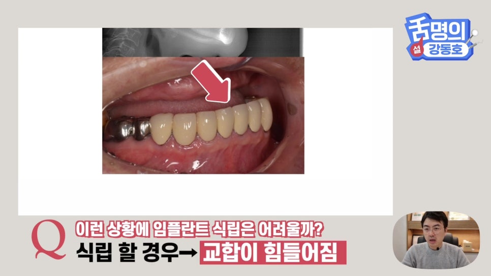 Dental Implants at Sillim Station: When There Is Not Enough Jawbone image 5