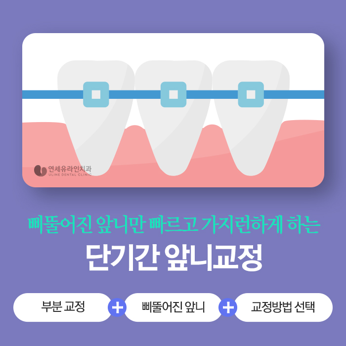 앞니부분교정기간 눈 깜짝 할 사이에! 관련 이미지 1