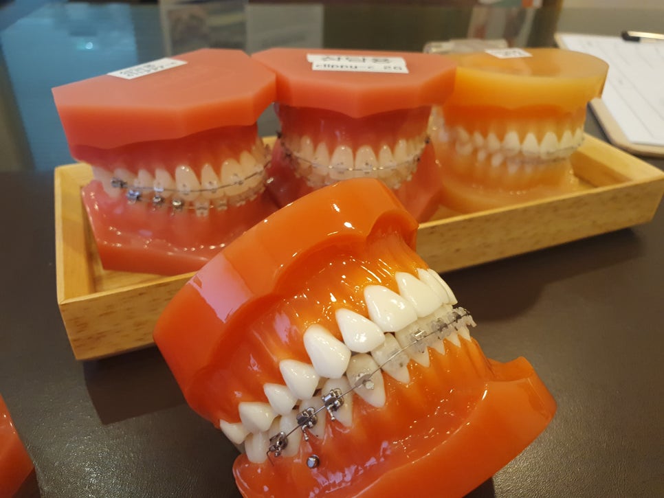 치아부분교정 가격 이제부터가 시작이야 관련 이미지 4