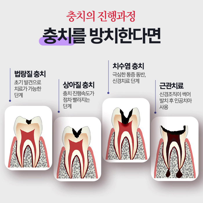 봉천동치과 스케일링 꼭 받는게 좋아요 관련 이미지 7