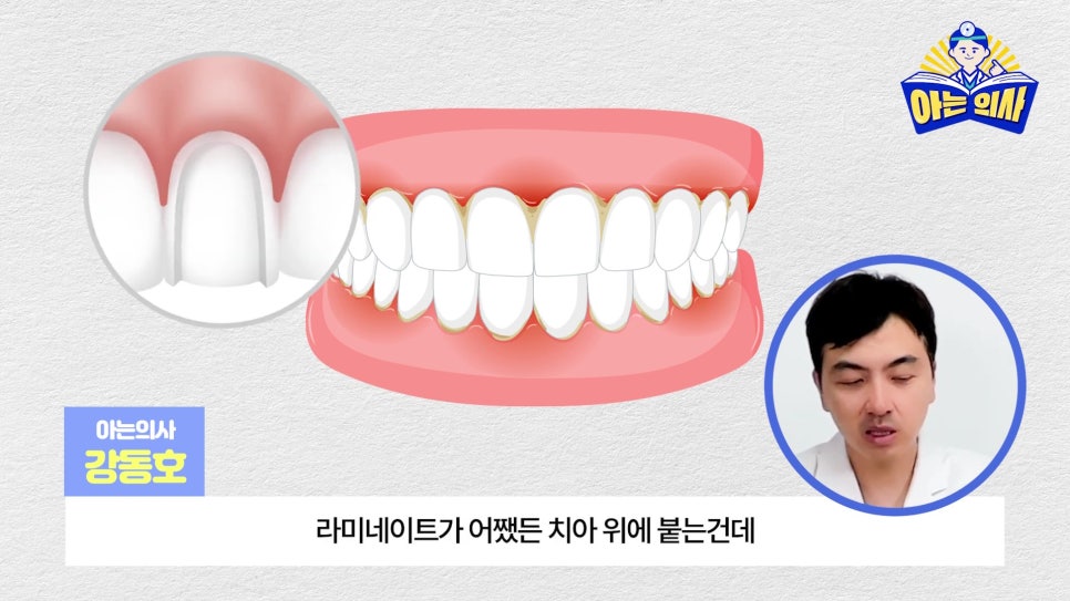 무삭제라미네이트, 단점 알고해야 관련 이미지 7