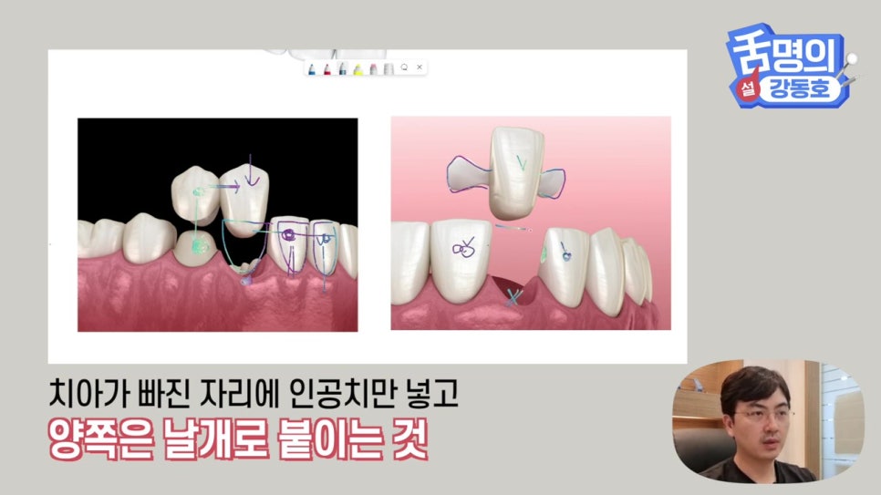 신림동치과, 브릿지치료 치아삭제 부담된다면? 관련 이미지 19