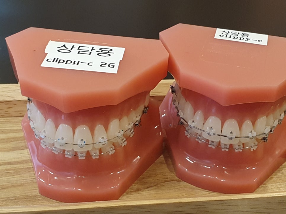 앞니부분교정비용 가벼운 변신을 관련 이미지 3