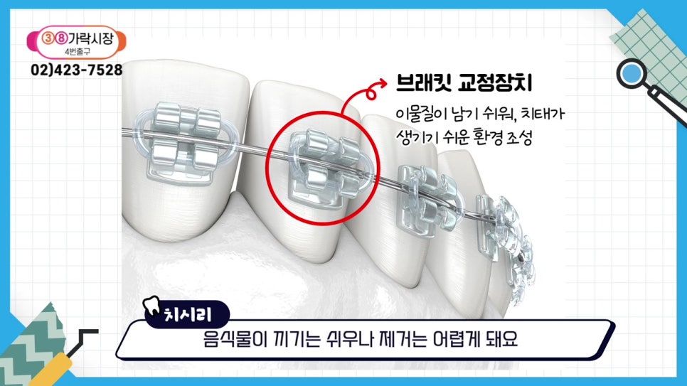 관악구치아교정, 빨리 끝내고 싶어? 관련 이미지 10