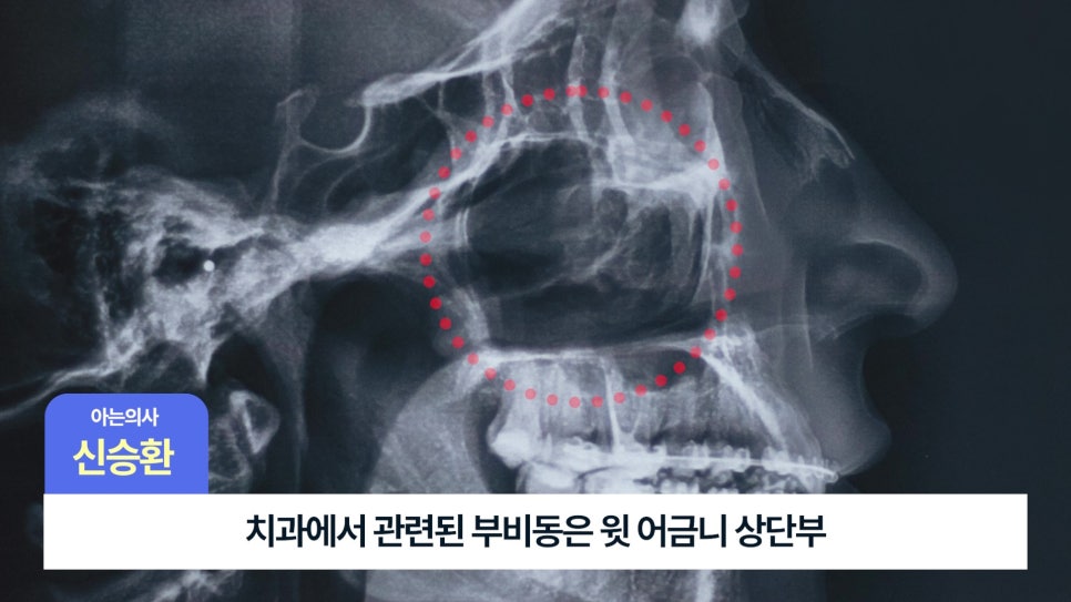 Songpa-gu Dental Implants: Is Sinus Lift Surgery Necessary? image 4