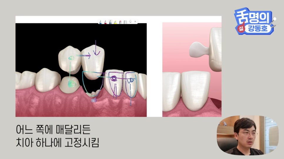 신림동치과, 브릿지치료 치아삭제 부담된다면? 관련 이미지 13