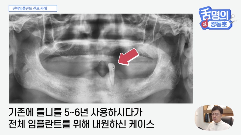 관악구치과 - 전체 임플란트, 시간&middot;횟수&middot;개수 총정리 관련 이미지 2