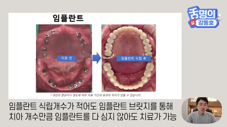 신림동치과, 다수의 치아상실 후.. 관련 이미지 12