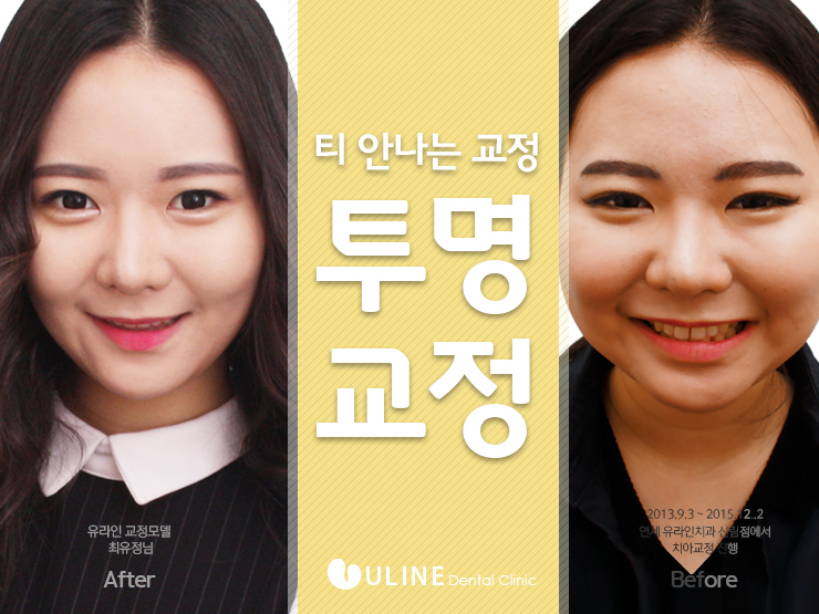 투명교정후기 궁금하면 냉큼오슈 관련 이미지 6