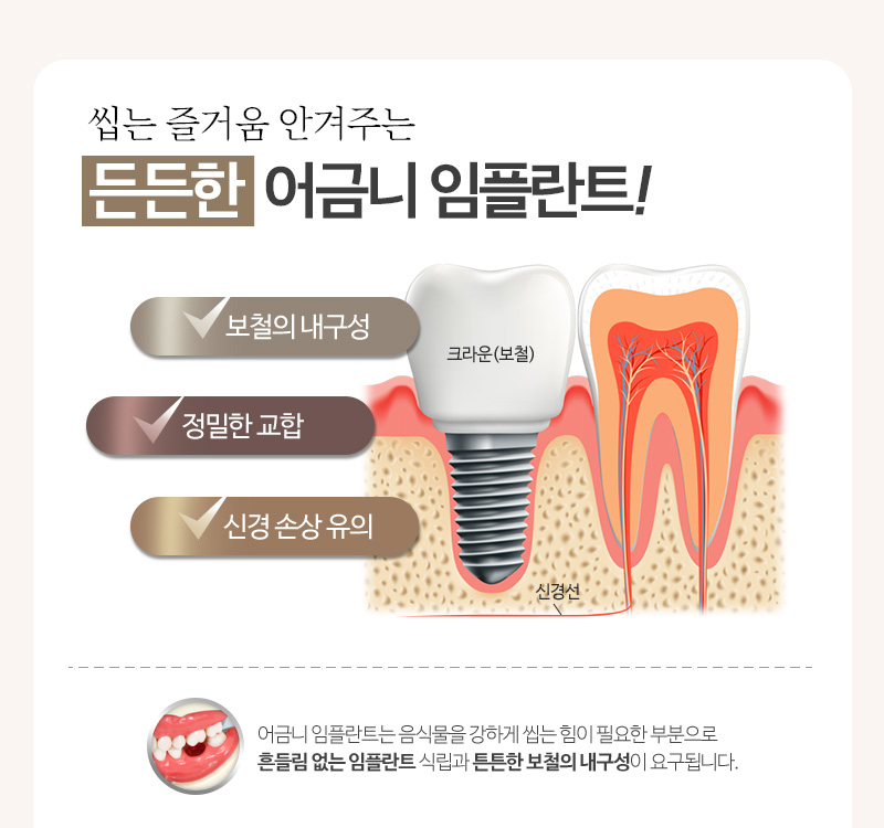 어금니임플란트가격에 대한 걱정되는마음을 관련 이미지 4