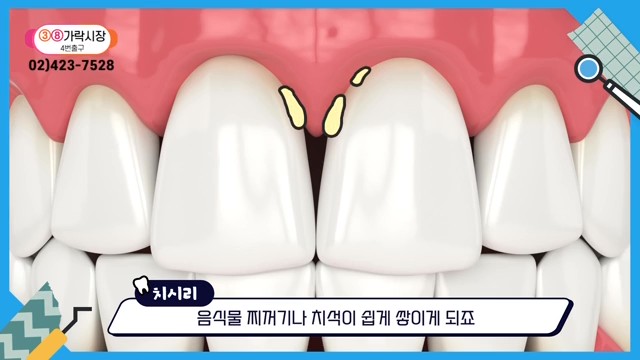 Can the Gaps Between Your Teeth That Make You Look Older Be Fixed? image 21