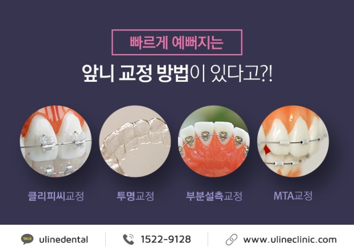 앞니교정후기 토끼이빨 같았던 내모습이 변했다 관련 이미지 4