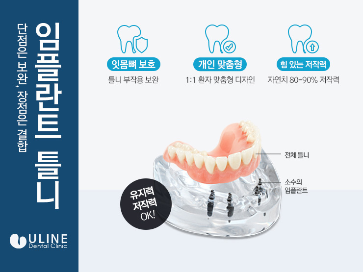 임플란트틀니기간 줄이고 기술은 높였다 관련 이미지 4