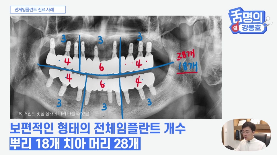 관악구치과 - 전체 임플란트, 시간&middot;횟수&middot;개수 총정리 관련 이미지 15