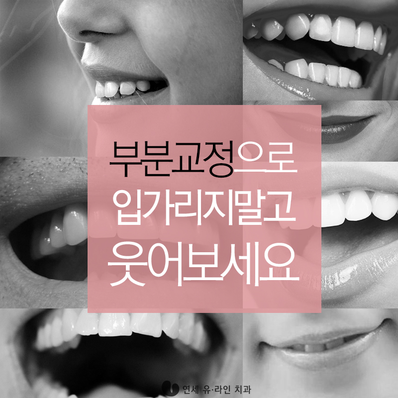 벌어진앞니교정 콤플렉스 빠이! 관련 이미지 5