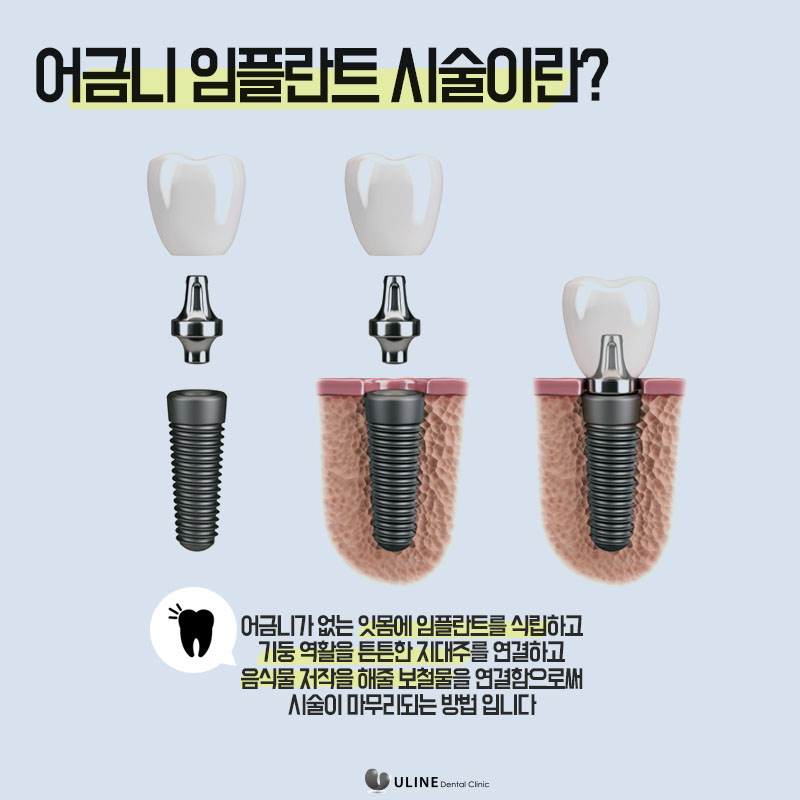 어금니임플란트통증 모두 줄였다! 관련 이미지 5