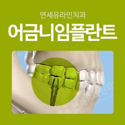 사당치과 어금니임플란트가격은 OO이다! 관련 이미지 1
