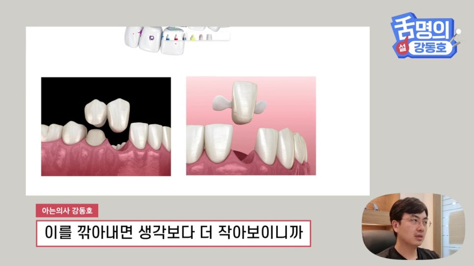 신림동치과, 브릿지치료 치아삭제 부담된다면? 관련 이미지 6