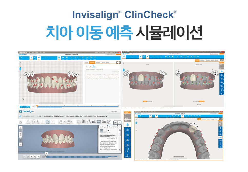 동작구치과 장치 착용, 돌출입 걱정 없어 관련 이미지 7
