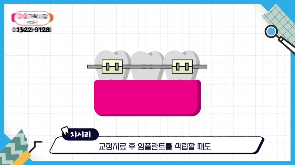 역삼동치과, 치아 빠진 뒤 빠르게 대처해야 하는 이유 관련 이미지 17